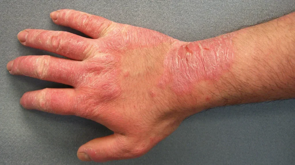ampollas-en-la-mano
